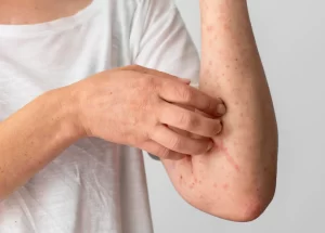 skin-allergy-reaction-person