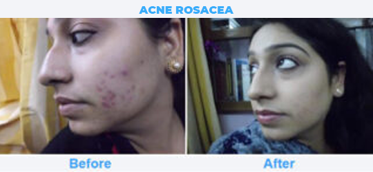 ACNE-ROSACEA