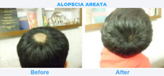 ALOPECIA-AREATA 2