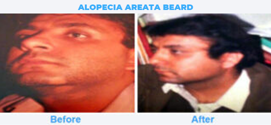 ALOPECIA-AREATA-BEARD