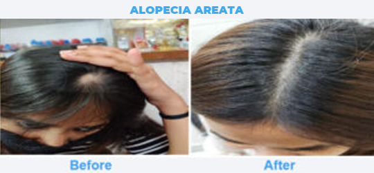ALOPECIA-AREATA