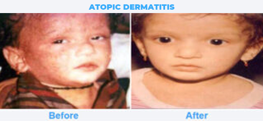 ATOPIC-DERMATITIS-2