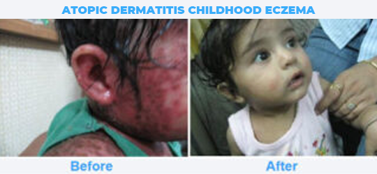 ATOPIC-DERMATITIS-CHILDHOOD-ECZEMA