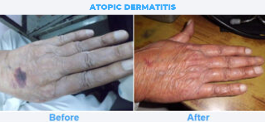 ATOPIC-DERMATITIS