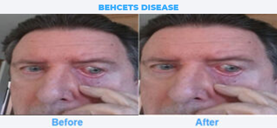 BEHCETS-DISEASE