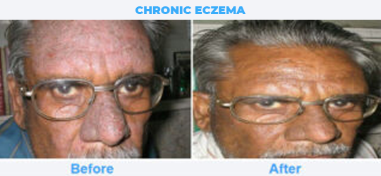 CHRONIC-ECZEMA