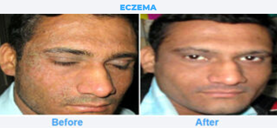 ECZEMA