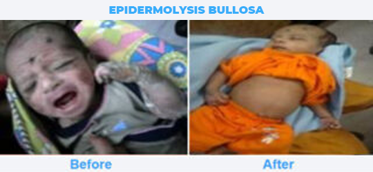 EPIDERMOLYSIS-BULLOSA