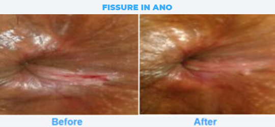 FISSURE-IN-ANO
