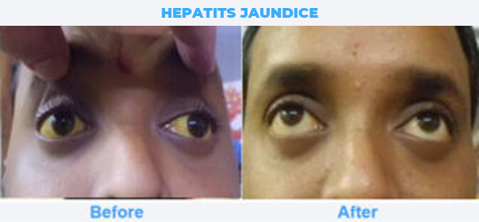 HEPATITS-JAUNDICE