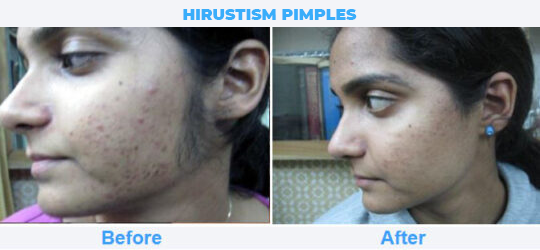 HIRUSTISM-PIMPLES