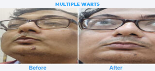 MULTIPLE-WARTS