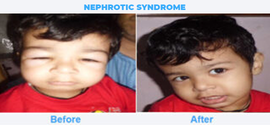 NEPHROTIC-SYNDROME