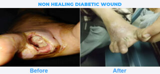 NON-HEALING-DIABETIC-WOUND-1
