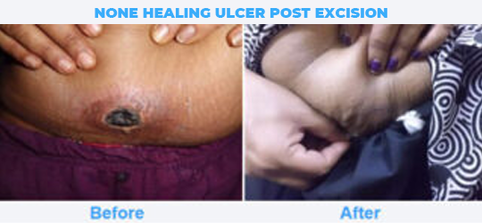 NONE-HEALING-ULCER-POST-EXCISION