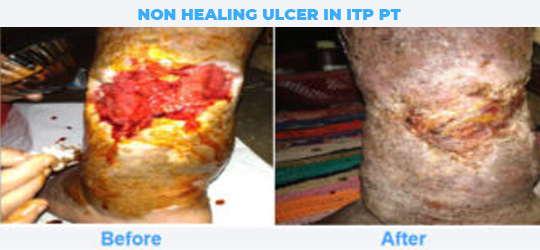 Non-Healing-Ulcer-in-ITP-Pt