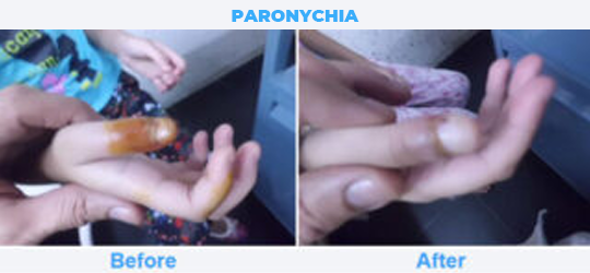 PARONYCHIA