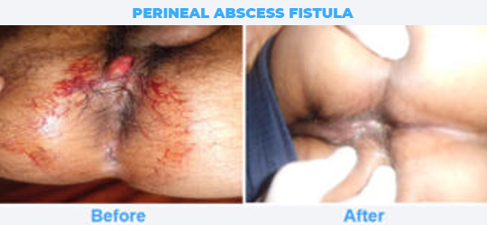 PERINEAL-ABSCESS-FISTULA