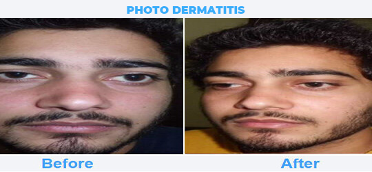 PHOTO-DERMATITIS