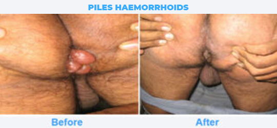 PILES-HAEMORRHOIDS