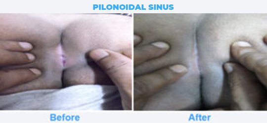 PILONOIDAL-SINUS