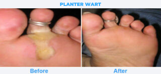 PLANTER-WART