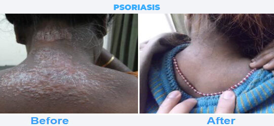 PSORIASIS