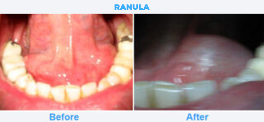 RANULA