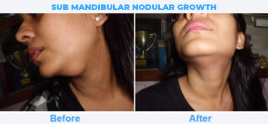 SUB-MANDIBULAR-NODULAR-GROWTH