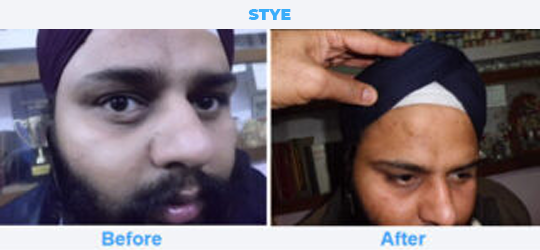 Stye