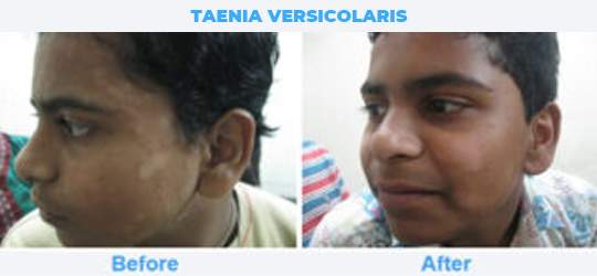 TAENIA-VERSICOLARIS