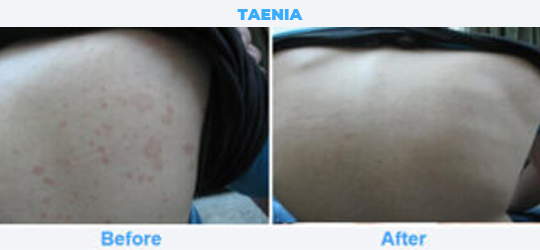 TAENIA