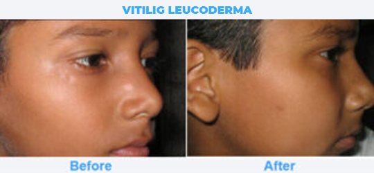 VITILIG-LEUCODERMA